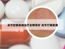 关节型银屑病治疗去哪家好 关节行银屑病