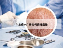 牛皮癣小广告如何清理最佳