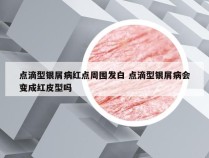 点滴型银屑病红点周围发白 点滴型银屑病会变成红皮型吗