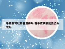 牛皮癣可以用卷发棒吗 有牛皮病癣能去烫头发吗