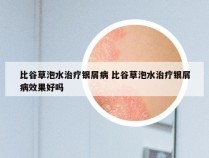 比谷草泡水治疗银屑病 比谷草泡水治疗银屑病效果好吗