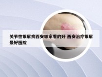 关节性银屑病西安哪家看的好 西安治疗银屑最好医院