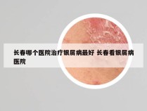 长春哪个医院治疗银屑病最好 长春看银屑病医院