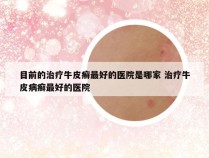 目前的治疗牛皮癣最好的医院是哪家 治疗牛皮病癣最好的医院