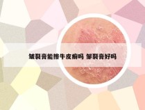 皱裂膏能擦牛皮癣吗 邹裂膏好吗