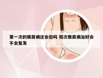 第一次的银屑病还会犯吗 初次银屑病治好会不会复发