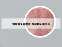 银屑病头部图片 银屑病头顶图片