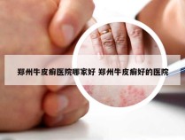 郑州牛皮癣医院哪家好 郑州牛皮癣好的医院
