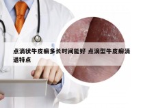 点滴状牛皮癣多长时间能好 点滴型牛皮癣消退特点