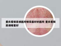重庆看银屑病医院哪家最好的医院 重庆看银屑病哪里好