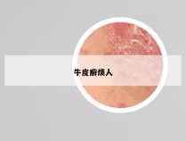 牛皮癣烦人