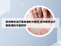 郑州哪有治疗银屑病的中医院 郑州哪有治疗银屑病的中医院好