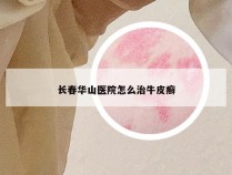 长春华山医院怎么治牛皮癣