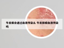 牛皮癣会通过血液传染么 牛皮肤癣血液传染吗