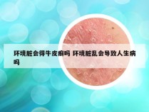 环境脏会得牛皮癣吗 环境脏乱会导致人生病吗