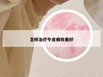 怎样治疗牛皮癣效果好