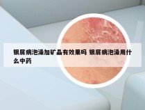 银屑病泡澡加矿晶有效果吗 银屑病泡澡用什么中药