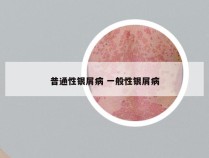 普通性银屑病 一般性银屑病