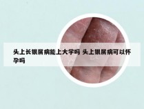 头上长银屑病能上大学吗 头上银屑病可以怀孕吗