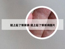 腿上起了银屑病 腿上起了银屑病图片