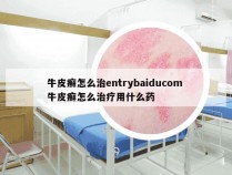 牛皮癣怎么治entrybaiducom 牛皮癣怎么治疗用什么药