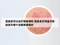 氨肽素可以治疗银屑病吗 氨肽素片和复方氨肽素片哪个治银屑病更好