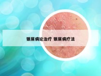银屑病论治疗 银屑病疗法