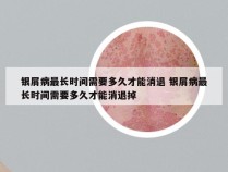 银屑病最长时间需要多久才能消退 银屑病最长时间需要多久才能消退掉