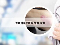 大黄泡茶牛皮癣 牛黄 大黄