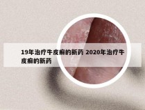 19年治疗牛皮癣的新药 2020年治疗牛皮癣的新药