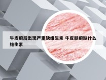 牛皮癣后出现严重缺维生素 牛皮肤癣缺什么维生素