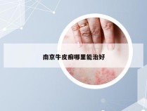 南京牛皮癣哪里能治好