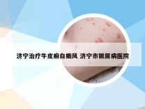 济宁治疗牛皮癣白癜风 济宁市银屑病医院