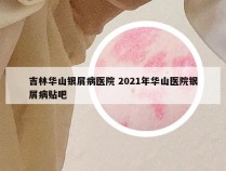 吉林华山银屑病医院 2021年华山医院银屑病贴吧