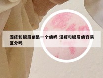 湿疹和银屑病是一个病吗 湿疹和银屑病容易区分吗