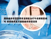 醋酸曲安奈德露霉素溶液能治疗牛皮癣银屑病吗 银屑病用复方醋酸曲安奈德溶液