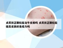 贞芪扶正颗粒能治牛皮癣吗 贞芪扶正颗粒能提高皮肤的免疫力吗