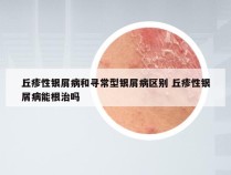 丘疹性银屑病和寻常型银屑病区别 丘疹性银屑病能根治吗