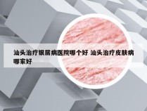 汕头治疗银屑病医院哪个好 汕头治疗皮肤病哪家好