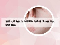 清热化毒丸能治血热型牛皮癣吗 清热化毒丸能祛湿吗
