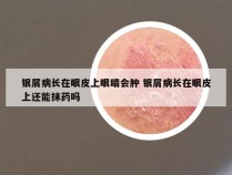银屑病长在眼皮上眼睛会肿 银屑病长在眼皮上还能抹药吗