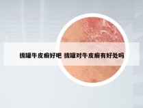 拔罐牛皮癣好吧 拔罐对牛皮癣有好处吗