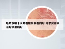 哈尔滨哪个大夫看银屑病看的好 哈尔滨哪家治疗银屑病好