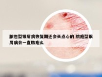 脓包型银屑病恢复期还会长点心的 脓疱型银屑病会一直脓疱么