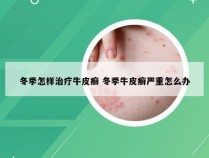 冬季怎样治疗牛皮癣 冬季牛皮癣严重怎么办