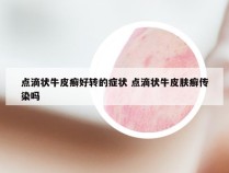 点滴状牛皮癣好转的症状 点滴状牛皮肤癣传染吗