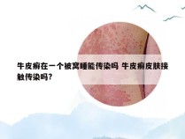 牛皮癣在一个被窝睡能传染吗 牛皮癣皮肤接触传染吗?