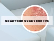 发烧后好了银屑病 发烧后好了银屑病会好吗