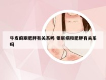 牛皮癣跟肥胖有关系吗 银屑病和肥胖有关系吗
