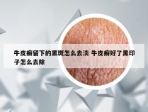 牛皮癣留下的黑斑怎么去淡 牛皮癣好了黑印子怎么去除